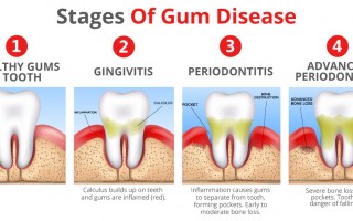 stages-of-gum-disease-web-graphic-3