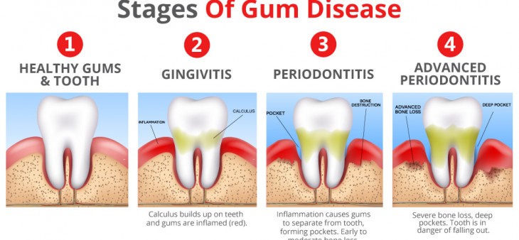 stages-of-gum-disease-web-graphic-3